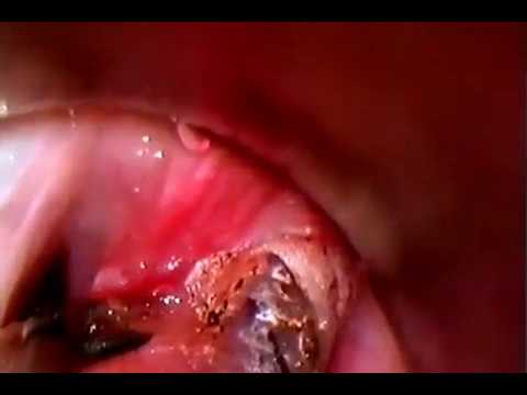 MCO 25plus – Micro Point cordectomy