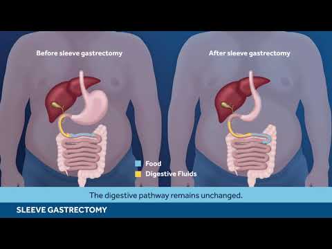 Bariatrische Türkei NAMIK YILMAZ - SLEEVE GASTRECTOMY