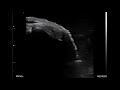 Wrist Dorsal Compartment Scanning With Standoff Pad POCUS Ultrasonography