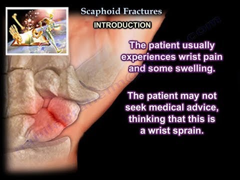 Scaphoid törés és csukló fájdalom diagnózis - Ortopédia - 