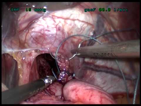 comment traiter dysphagie