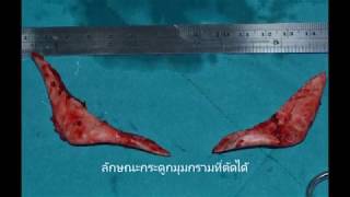 ผ่าตัดปรับโครงหน้า V-line