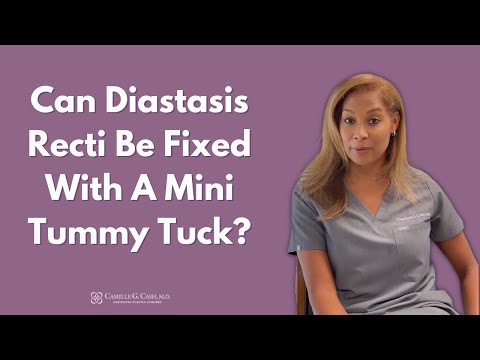 Can Diastasis Recti Be Repaired With a Mini Tummy Tuck? | Houston | Dr. Camille Cash
