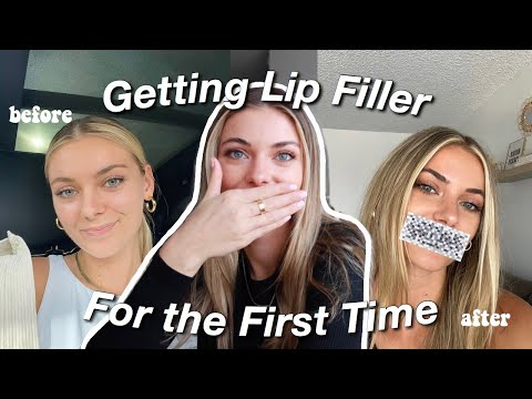 Getting Lip Filler for the First Time + What It Looks Like Months Later