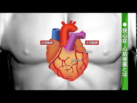 心筋梗塞 - 定義