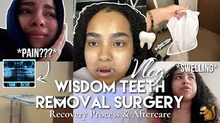 I GOT MY WISDOM TEETH REMOVED VLOG 🦷 FULL RECOVERY PROCESS & AFTERCARE TIPS!