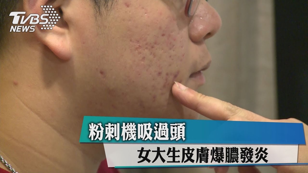 粉刺機吸過頭 女大生反長爛痘爆膿發炎