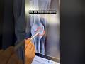 Knee And Joint Pain Treatment Swelling Pain Treatment Trend Ytviral Short