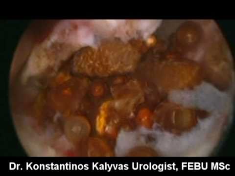 Analisi di prostata analisi decodifica allocazione Acquistare candele in vitaprost Gorzdrav