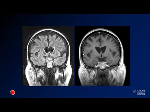 Neuroradiology board review lecture 1 case 1
