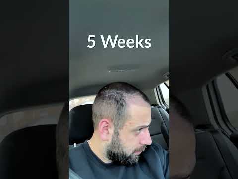 Hair Transplant Process - Week by Week - 3 Months
