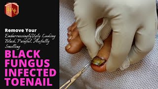 How I Had My Dead, Embarrassingly Ugly Looking, Awfully Smelling Black Toenail Surgically Removed.
