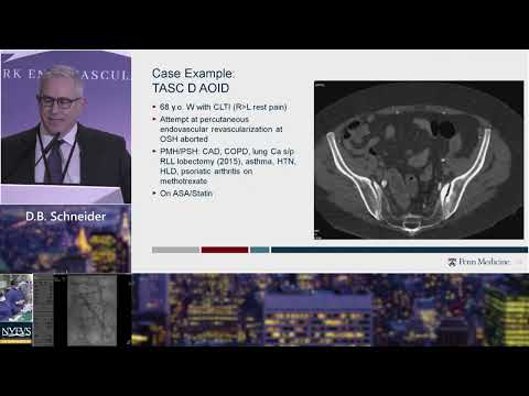 Endovascular Technique for Bilateral Ostial Iliac Disease with Distal Aortic Involvement   D  B Schn