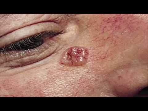 When Melanoma is More Thank Skin Deep