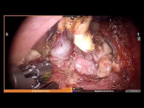 Robotic Prostate Cancer Removal