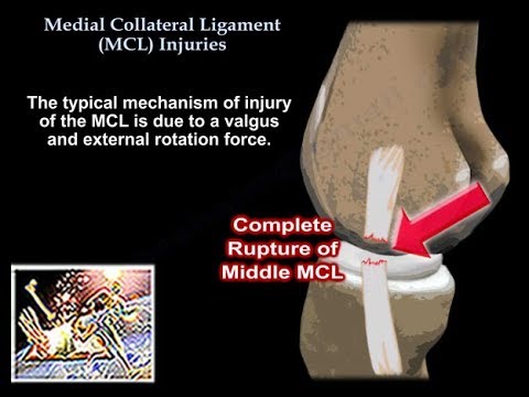 Medial Collateral Ligament Injuries - Everything You Need To Know - Dr. Nabil Ebraheim