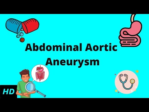 Abdominal Aortic Aneurysm, Causes, Signs and Symptoms, Diagnosis and Treatment.