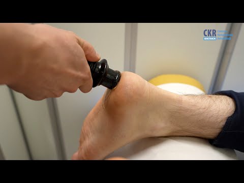 Ostroga piętowa - jak leczyć i zapobiegać?