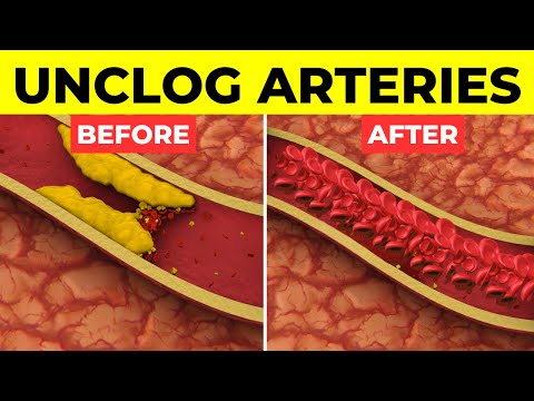 Top 5 Foods To Clean Arteries And Prevent Heart Attacks