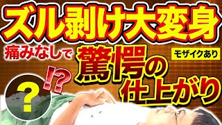 【リアル手術】皮被りに別れ！ズル剥けに変身するまでノーカット密着！【包茎手術】