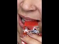 So What CAN You Eat With Braces