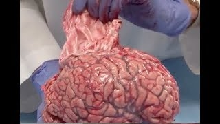 Bloedvoorziening van de grote hersenen