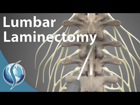 Lumbar Laminectomy