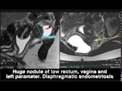 Huge low rectal endometriosis and sacral roots compression