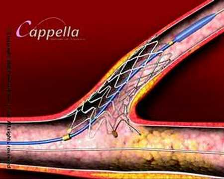 3D medical animation Cardiology heart valve stent