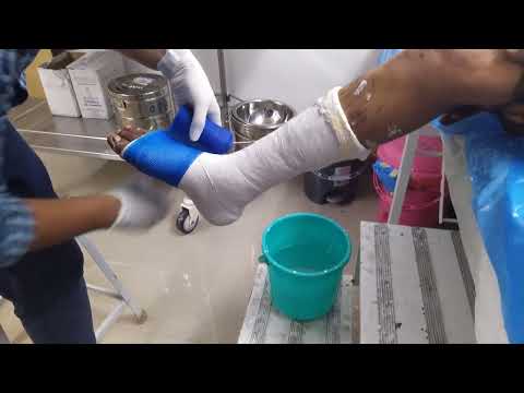 Below Knee Cast application l Dr Sunny Dole