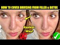 How To Cover Bruising From Fillers And Botox The Easiest Way
