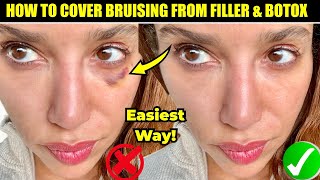 How to Cover Bruising from Fillers and Botox-The Easiest Way!