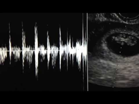 Gestação - 9 Semanas - As primeiras batidas do coração do nosso bebê.