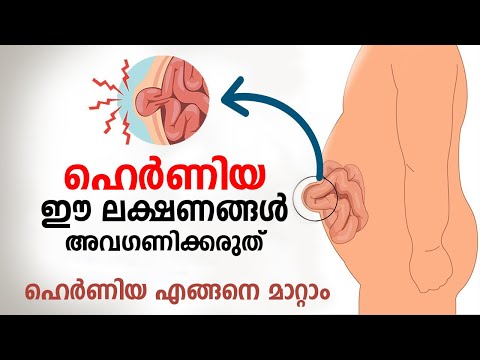 Don't ignore these symptoms of hernia disease | Hernia Malayalam | Hernia Symptoms