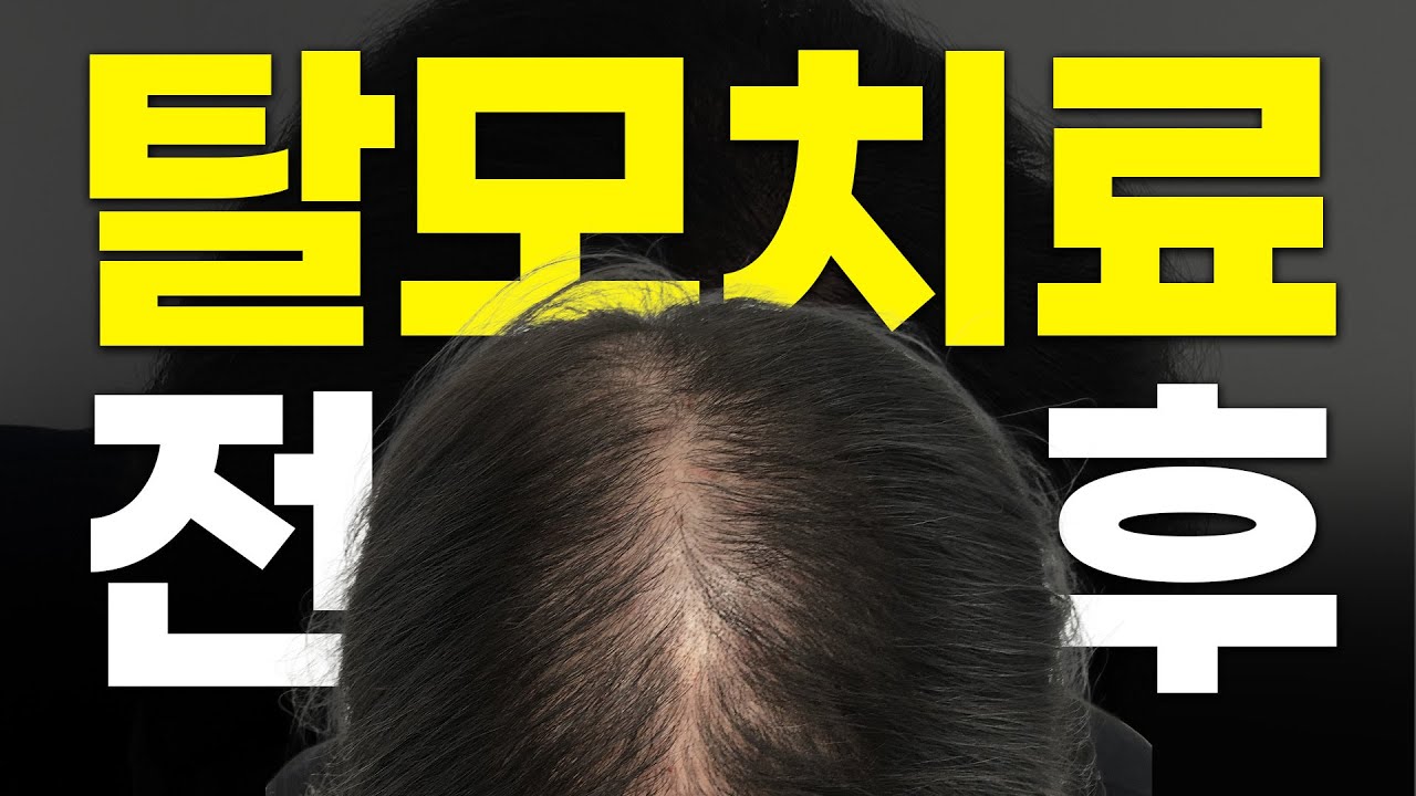 因为头发少而担心…… 这真的有效。