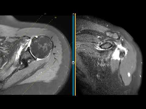 Massive rotator cuff tear in 58 year old