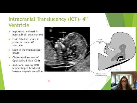 Beyond the ‘Nuchal’- Getting the Most from the 11-14 Week Ultrasound | Michelle Sutherland | AFIC