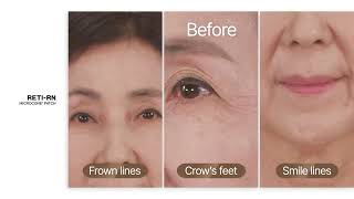 VCR3 3 B&A compare wrinkles
