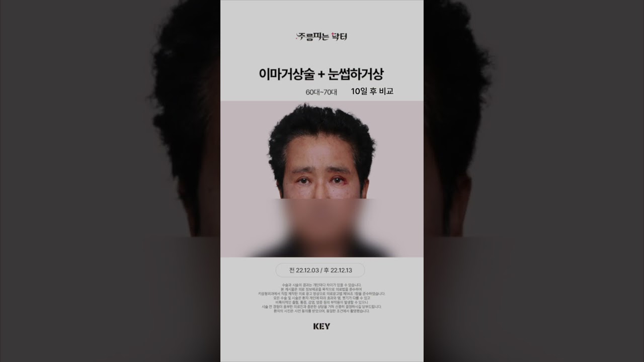 70대 이마거상 대구키성형외과