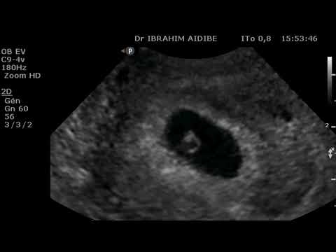 Embryon à 5 semaines d'aménorrhée