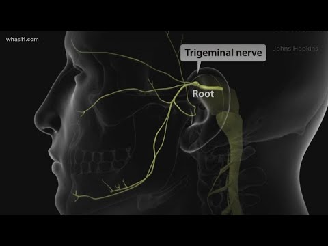 Trigeminal Neuralgia, local doctors may have found the cure
