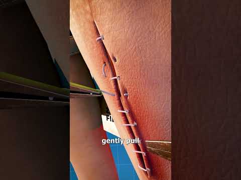 How Stitches Are Removed 🤔