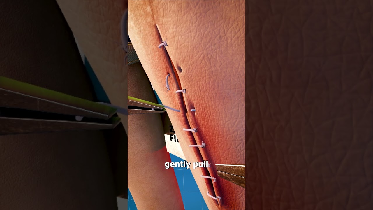 How Stitches Are Removed 🤔