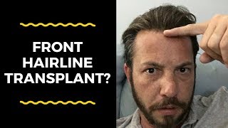 Hair Replacement Mens Hair System Review Front Hairline Transplant?