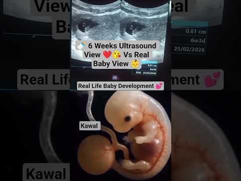 🍼 6 Weeks Ultrasound View ❤️😘 Vs Real Baby View 👶 #ultrasound #baby
