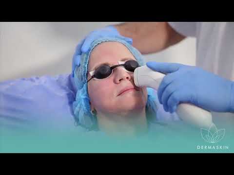 El Láser Fraccionado por dermatólogo en Cartagena - rejuvenecimiento facial