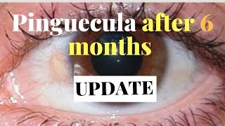How I fight pinguecula yellow spot on eyes after 6 months update/NO MORE RADISH JUICE