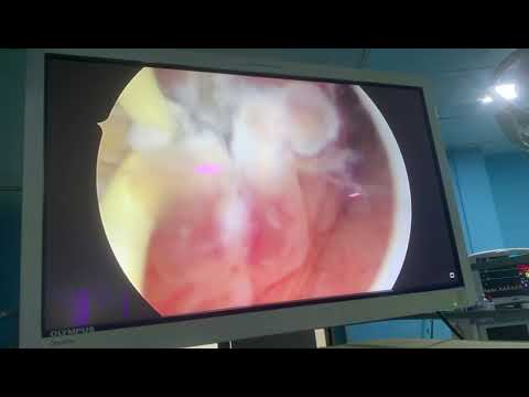 Ureterocoele Excision (Along with removal of calculus)