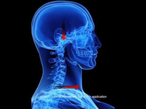 Gonartrosi al ginocchio Grado giunto 3 Infiammazione delle articolazioni delle terapie tradizionali piede