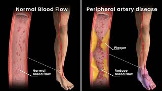 Peripheral Artery Disease Angioplasty